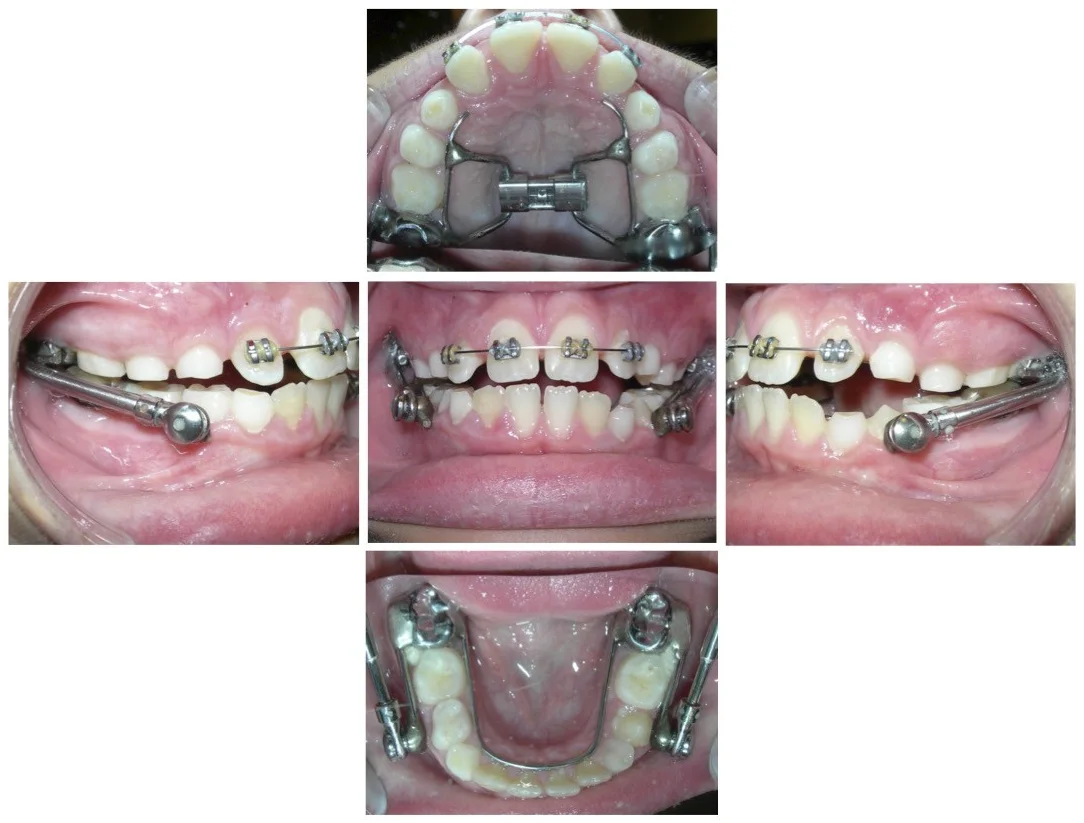 Herbst appliance on a young patient, shown from the left, front and right, plus top and bottom views of how it attaches to the back teeth