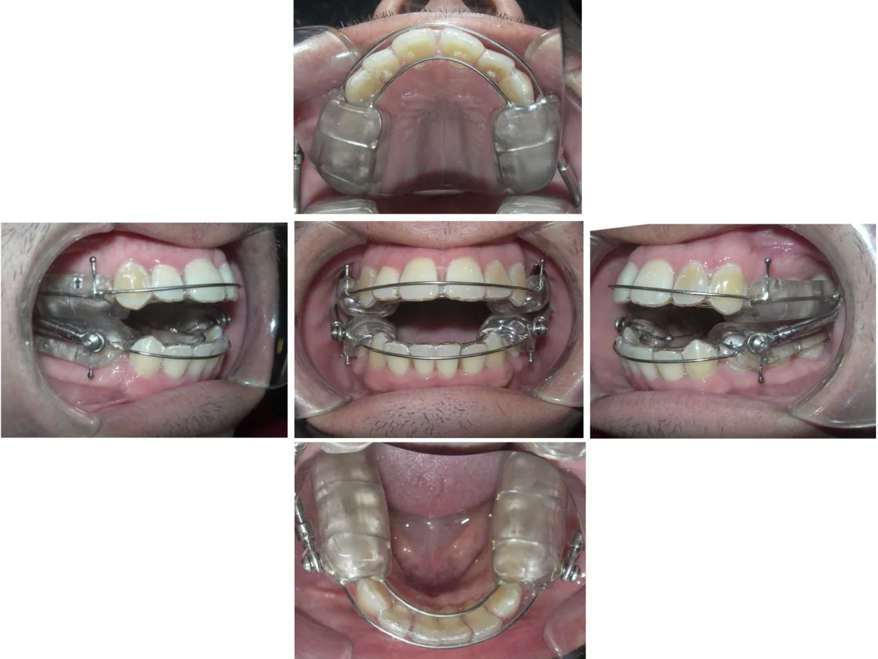 Herbst-style sleep apnea appliance worn together with Invisalign aligners, shown from five angles