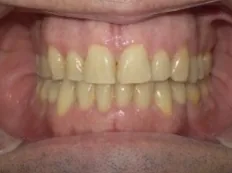 After treatment: lower teeth sat ahead of the uppers