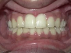 After treatment: crooked, crowded teeth with a crossbite