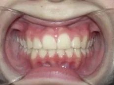After treatment: crowded teeth and a crossbite