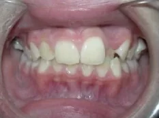 Before treatment: crowded teeth and a crossbite
