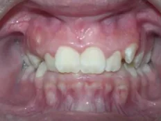 Before treatment: crowded teeth and a deep bite