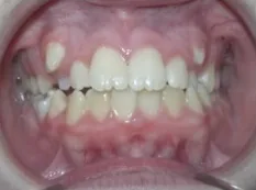 Before treatment: canines came in high and out of place