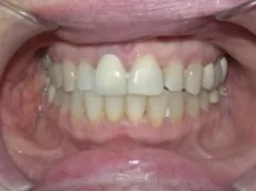 After treatment: front teeth met edge to edge