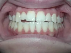 Before treatment: edge-to-edge front teeth