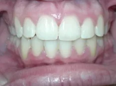 After treatment: overbite corrected without headgear
