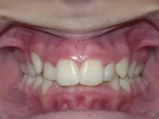 Before treatment: overbite corrected without headgear