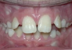 Before treatment: top teeth stuck far out