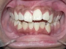 Before treatment: front teeth didn't touch