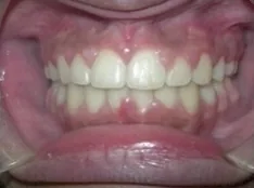 After treatment: top teeth stuck out past the bottoms