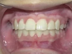 After treatment: severely crowded teeth