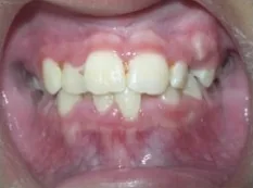 Before treatment: severely crowded teeth