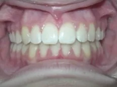 After treatment: top teeth covered the bottoms