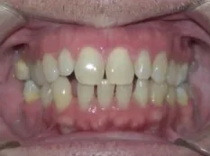 Before treatment: gaps closed for an adult patient