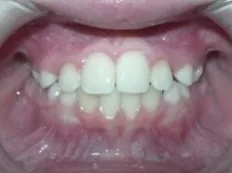 After treatment: underbite caught early