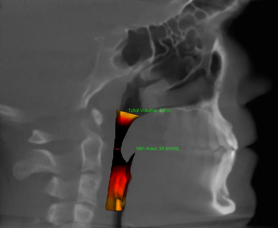 iCAT 3D scan with the airway highlighted in color, showing its total volume and narrowest point