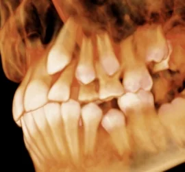 3D scan showing an impacted canine tooth above the other teeth