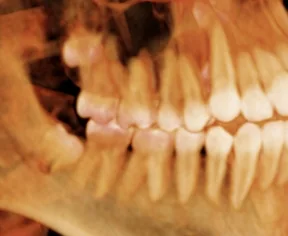 3D scan showing wisdom teeth at the back of the jaw